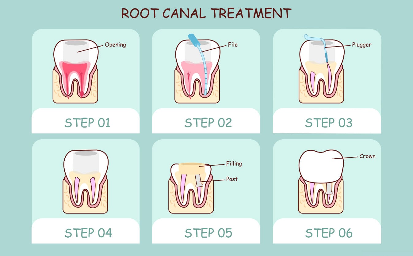 dentista RootCanalTreatment