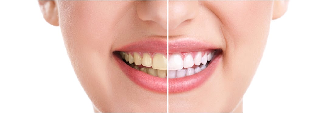 dentista TeethWhitening BeforeAfter