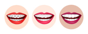 dentista rsz invisalign types of braces