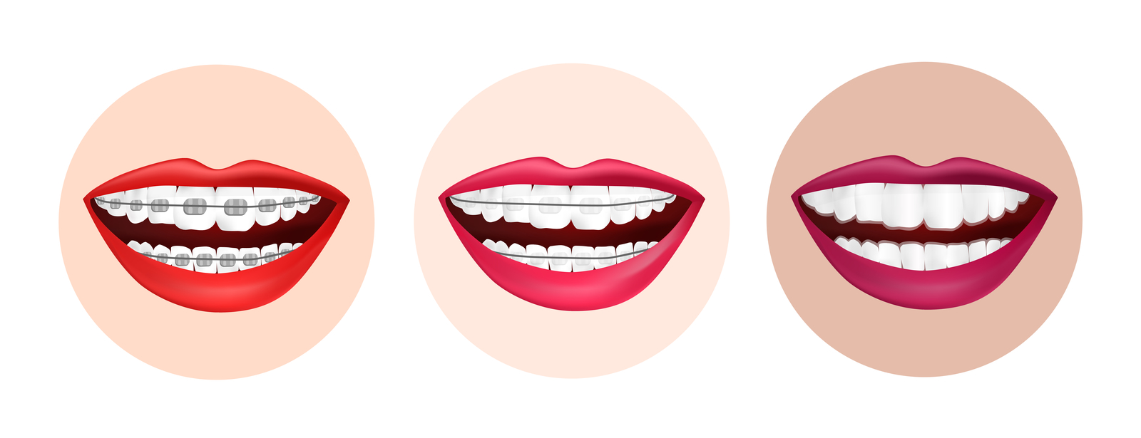 dentista rsz invisalign types of braces