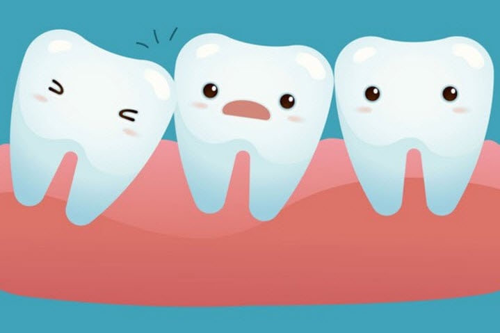 dentista wisdomteeth